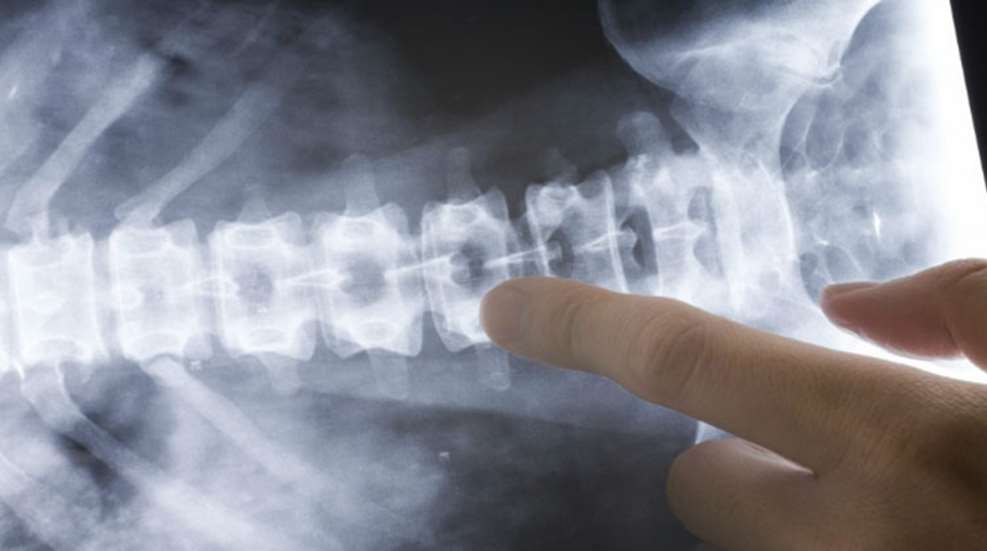 treatment-for-bone-spurs-in-back.jpg