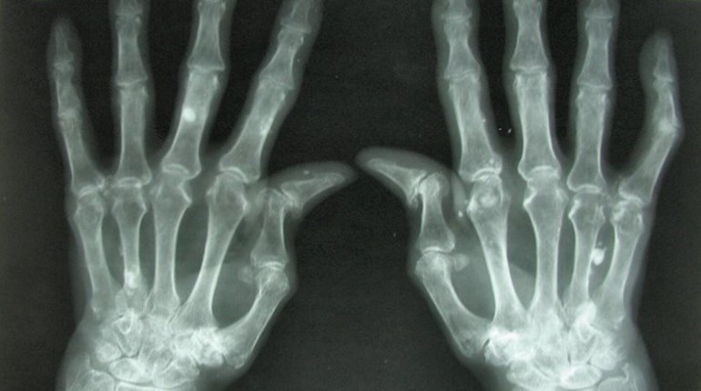 x ray of arthritic hands