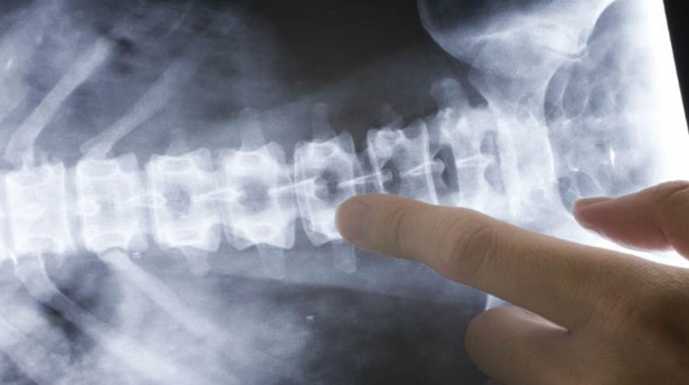 treatment-for-bone-spurs-in-back.jpg
