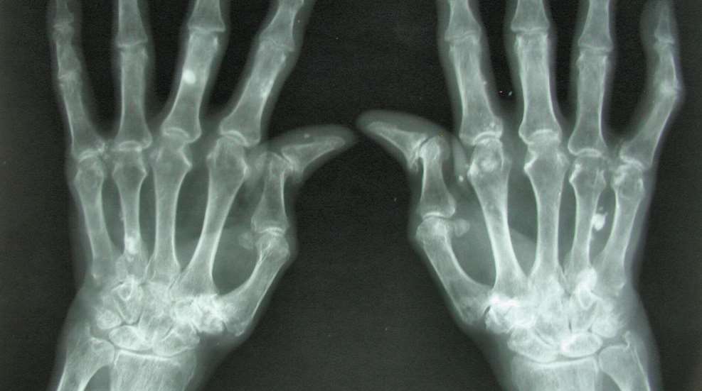 arthritis.jpg